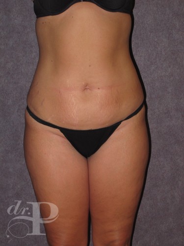 Case--1931 | Before Liposuction 1