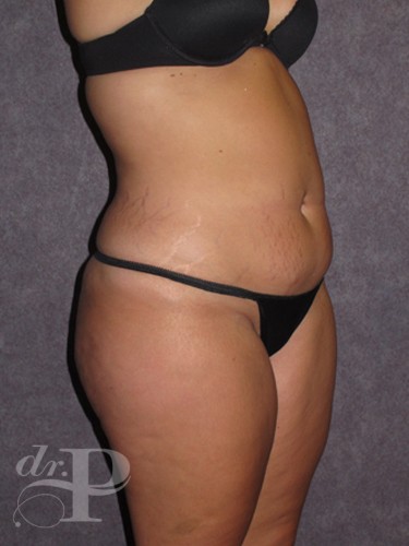 Case--1941 | Before True Form Tummy Tuck® 2