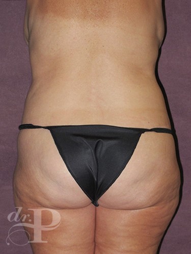 Case--1084 | After Liposuction 4