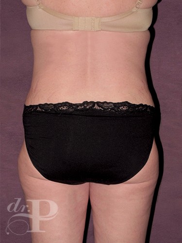Case--1337 | After Liposuction 4