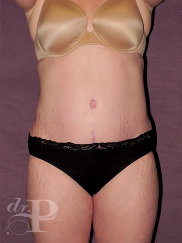 Case--1327 | After True Form Tummy Tuck® 1