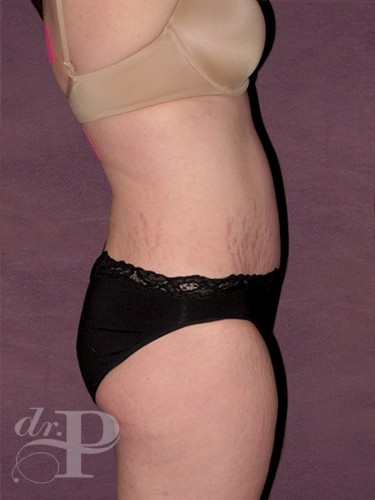Case--1337 | After Liposuction 3