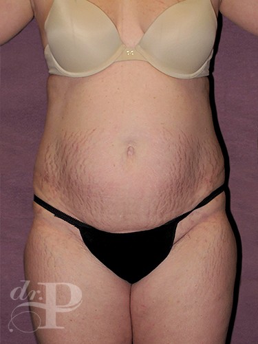 Case--1337 | Before Liposuction 1