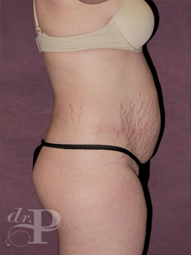 Case--1337 | Before Liposuction 3