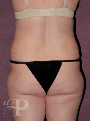 Case--1327 | Before True Form Tummy Tuck® 4
