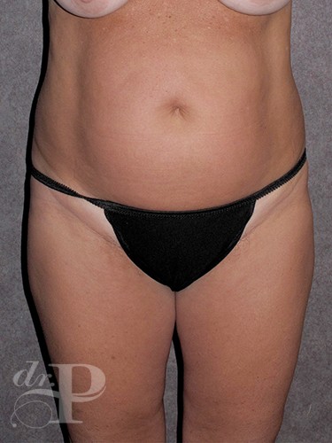 Case--202 | Before Liposuction 1