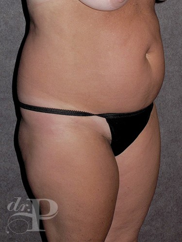 Case--216 | Before True Form Tummy Tuck® 5