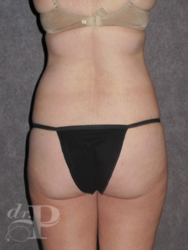 Case--1783 | Before Liposuction 4
