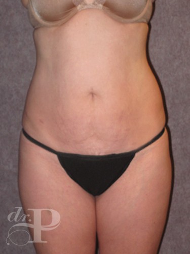 Case--1803 | Before True Form Tummy Tuck® 1