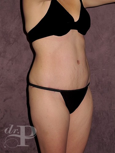 Case--1607 | After Liposuction 2