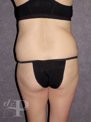 Case--1607 | Before Liposuction 4