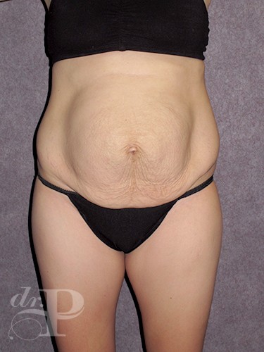 Case--1607 | Before Liposuction 1