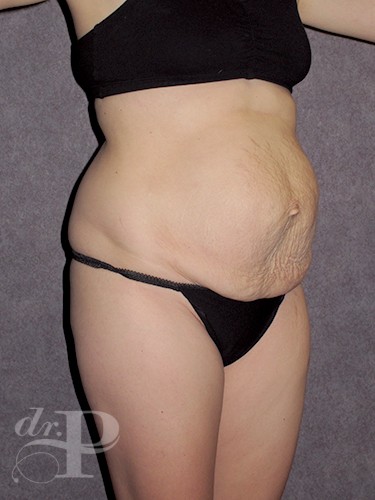 Case--1617 | Before True Form Tummy Tuck® 2