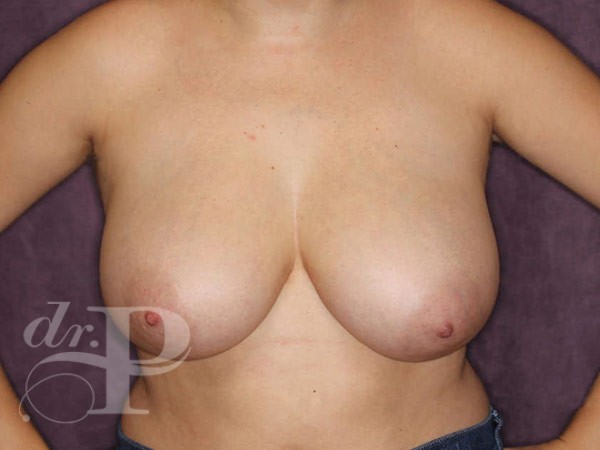 Case--31018 | Before Breast Lift 1
