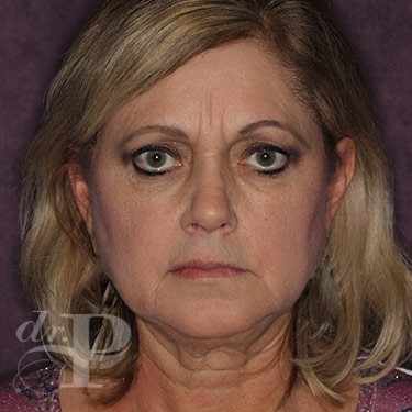 Case--31060 | Before Eyelid Surgery (Blepharoplasty) 1