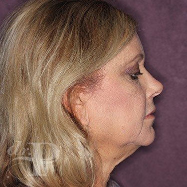 Case--31063 | Before Brow Lift 5