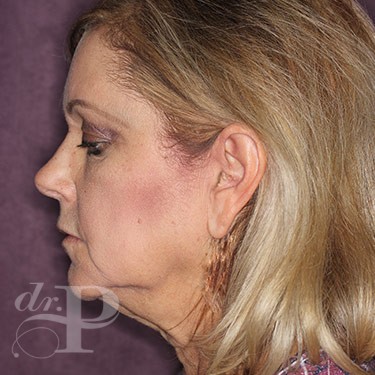 Case--31047 | Before Facelift and Neck Lift 3