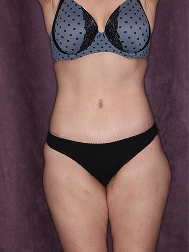 Case--34226 | After True Form Tummy Tuck® 1