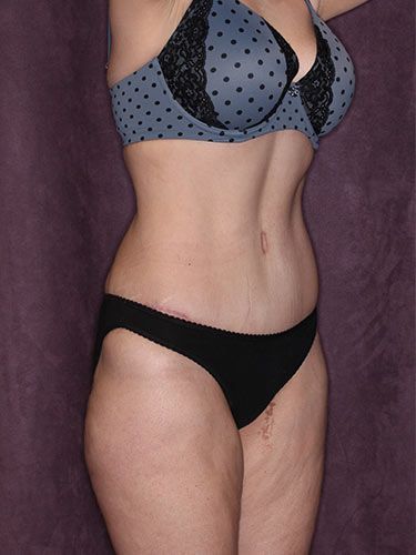 Case--34226 | After True Form Tummy Tuck® 2
