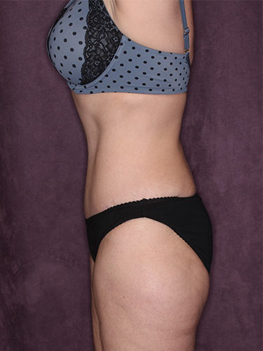 Case--34226 | After True Form Tummy Tuck® 5
