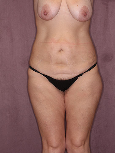 Case--34226 | Before True Form Tummy Tuck® 1