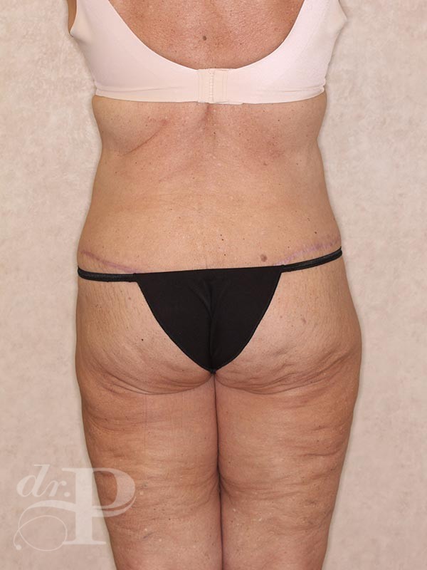 Case--30590 | After True Form Tummy Tuck® in Overweight & Weight Loss Patients 4