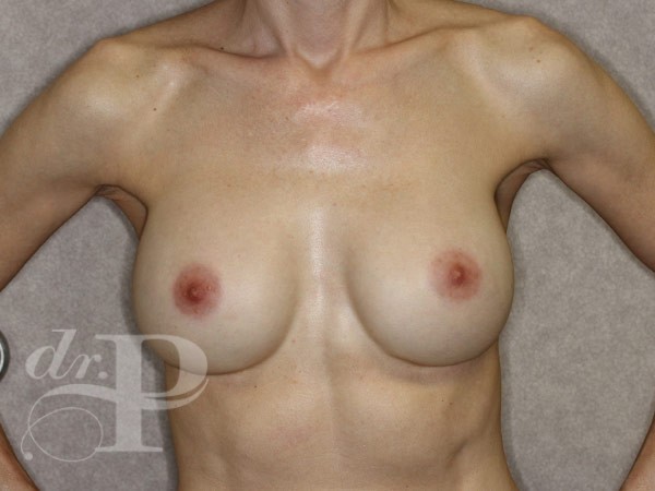 Case--31068 | After Corrective/Revision Breast Implant Surgery 1