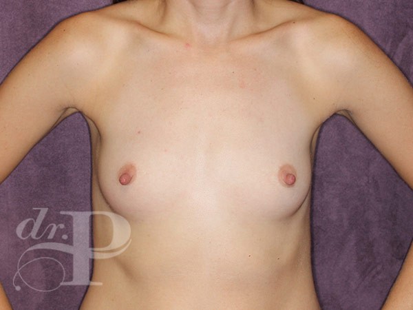 Case--30770 | Before Breast Augmentation 1