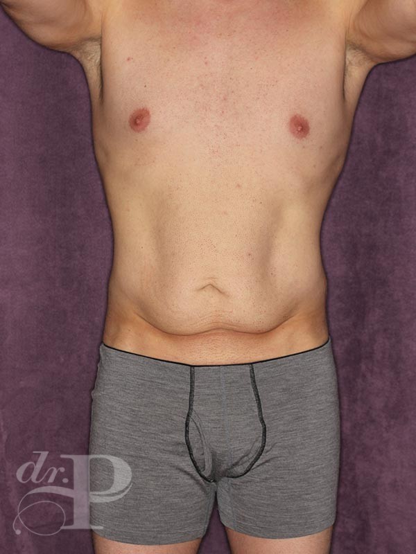 Case--27800 | Before Liposuction for Men 1