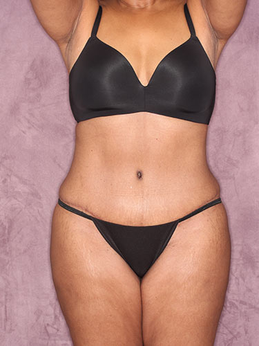 Case--32419 | After Fat Transfer to Buttocks 1