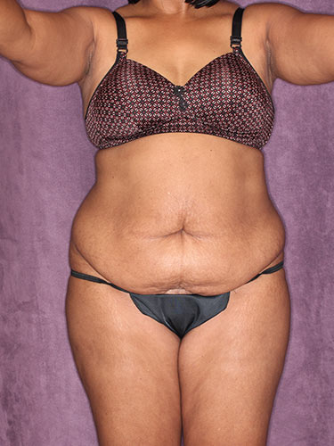 Case--32419 | Before Fat Transfer to Buttocks 1