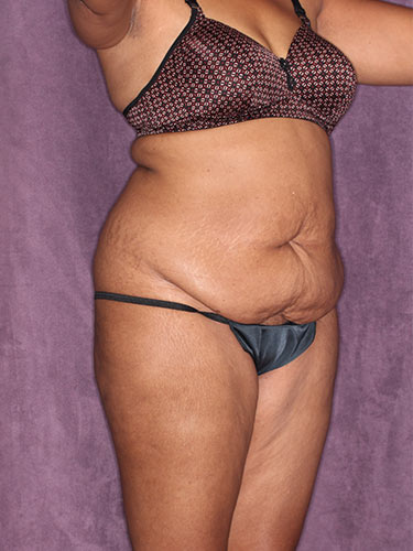 Case--32419 | Before Fat Transfer to Buttocks 2
