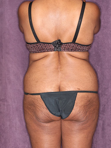 Case--32419 | Before Fat Transfer to Buttocks 7