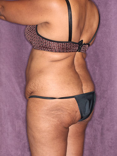 Case--32419 | Before Fat Transfer to Buttocks 5