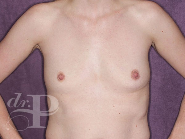 Case--30782 | Before Breast Augmentation 1