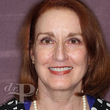 Case--31251 | After Eyelid Surgery (Blepharoplasty) 1