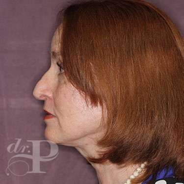 Case--31233 | After Facelift and Neck Lift 3