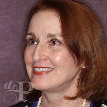 Case--31233 | After Facelift and Neck Lift 2