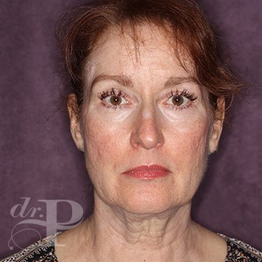Case--31253 | Before Brow Lift 1