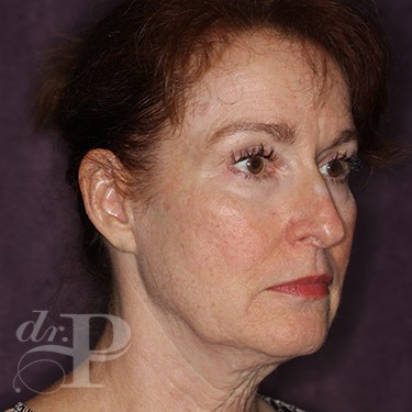Case--31233 | Before Facelift and Neck Lift 4