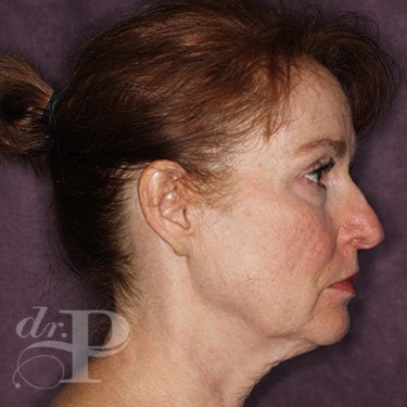 Case--31251 | Before Eyelid Surgery (Blepharoplasty) 5