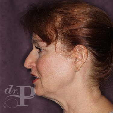 Case--31233 | Before Facelift and Neck Lift 3