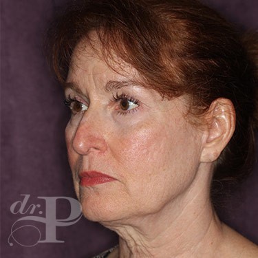Case--31253 | Before Brow Lift 2