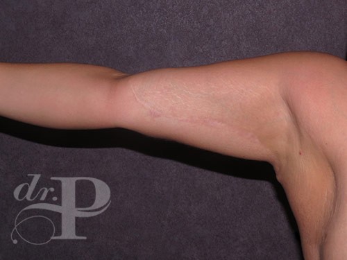 Case--31286 | After Arm Lift 1