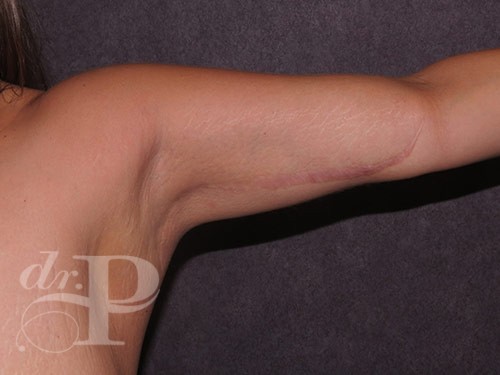 Case--31286 | After Arm Lift 2