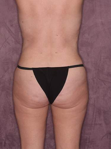 Case--36194 | After Fat Transfer to Buttocks 6