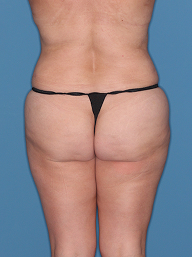Case--39208 | After Liposuction 6