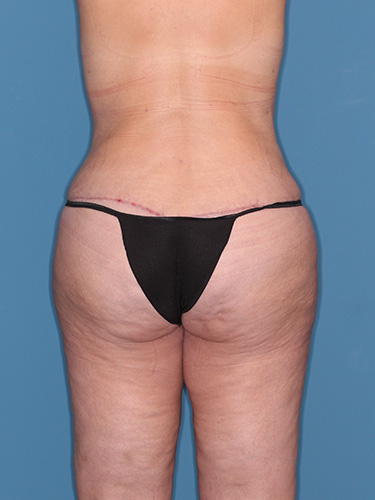 Case--39430 | After Fat Transfer to Buttocks 6