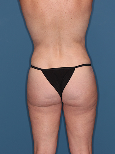 Case--39930 | After Liposuction 6