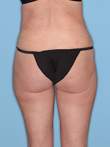 Case--39580 | After Liposuction 6